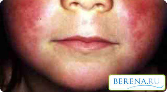 При скарлатине сыпь не поражает место между верхней губой и носом