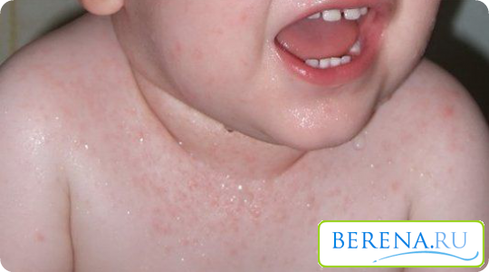 Чаще всего потница в виде красных точечек и пузырьков появляется на шее, животике и лице ребенка