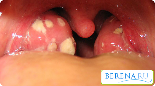 Когда красному горлу прибавляются белые пятна на миндалинах, необходима дифференцировка между ангиной и дифтерией. Тогда уже антибиотикотерапия здесь обязательна.