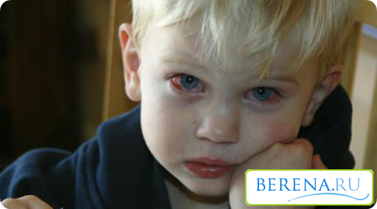 Болезнь характеризуется воспалением конъюнктивы одного или обоих глаз.
